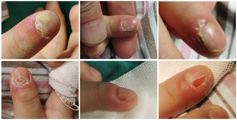 五岁儿童咬指甲感染脓液，安徽省儿童医院专家建议！